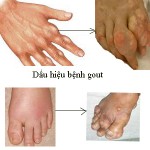 dau-hieu-benh-gut